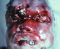 Exhibit 4: Terminal facial bloat after death and soaking.